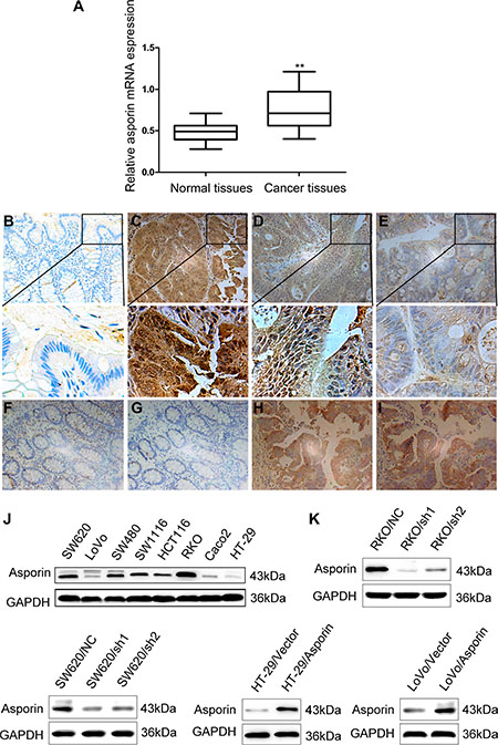 Expression of asporin in the CRC tissues and cell lines (200&#x00D7;).