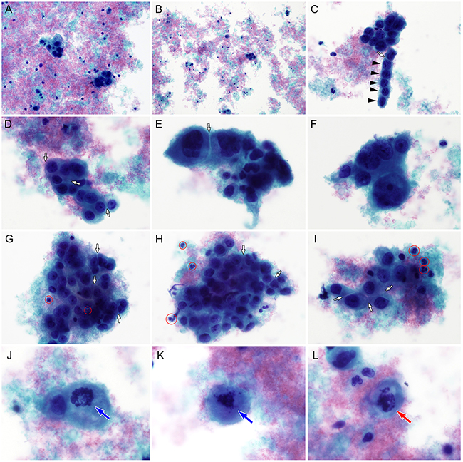 Liquid-based cytological findings of cervical glassy cell carcinoma.