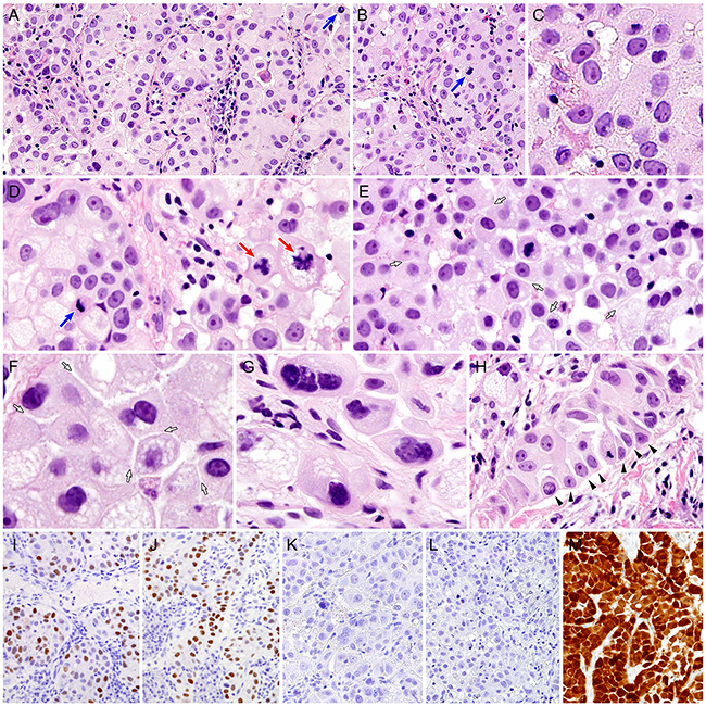 Histopathological and immunohistochemical findings of cervical glassy cell carcinoma.