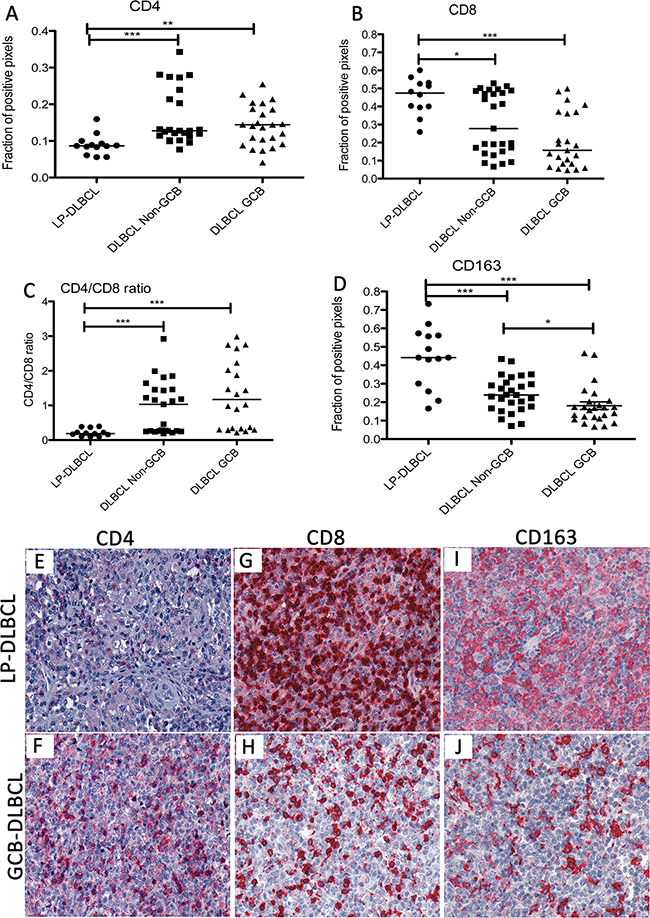 The inflammatory infiltrate in LP-DLBCL shows a low CD4/CD8 ratio and a high content of macrophages.