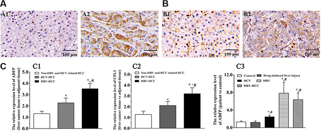 CFL1 and ADFP accumulated in human HBV-HCC liver samples.