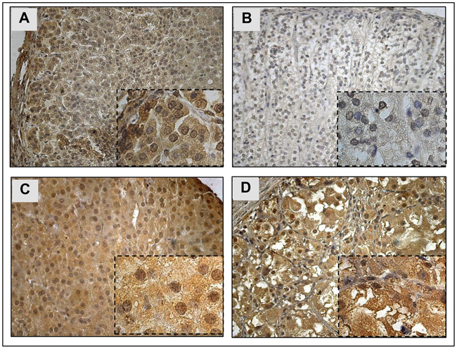 YAP1 protein* expression and localization in normal adrenal cortex and pediatric ACT.