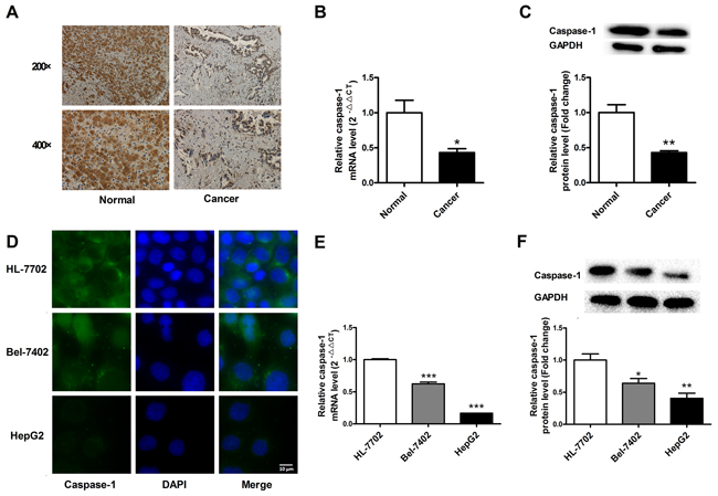 Loss of caspase-1 expression in human hepatocellular carcinoma (HCC) tissues and cells.