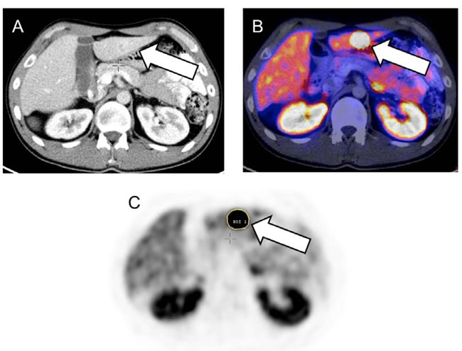 Figure 3.1: Baseline somatostatin receptor (SSTR) positron emission tomography/computed tomography (PET/CT) of a 24-year old male suffering from metastatic ileum neuroendocrine tumor.