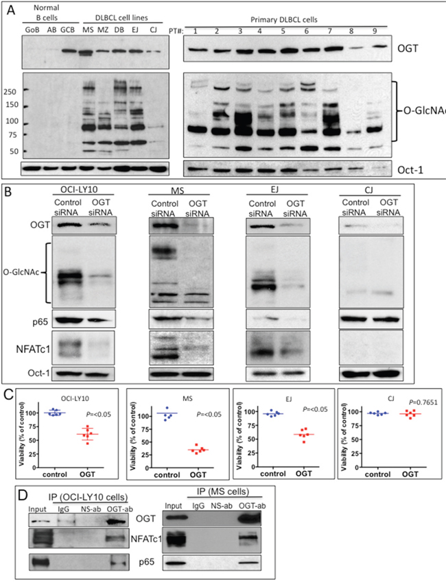 Elevated O-linked N-acetylglucosamine (O-GlcNAc) cycling (O-GlcNAcylation) and its association with nuclear factor of activated T-cells 1 (NFATc1) and nuclear factor kappa B (NF-&#x03BA;B)-p65 transcription factors in diffuse large B-cell lymphoma (DLBCL).