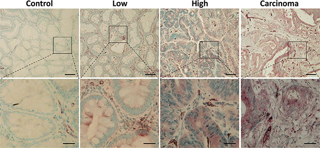Increasing expression of MMP-13 in colonic adenoma-carcinoma sequence.