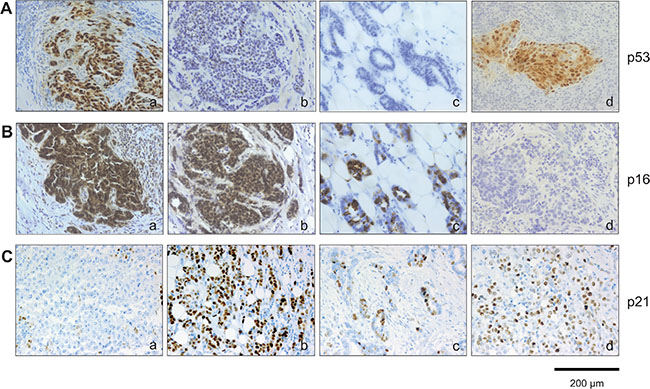 Immunohistochemical analysis of p53, p16INK4a and p21Cip1/Waf1 expression within breast cancer subtypes.