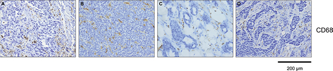 CD68 positive cells are differentially distributed between tumor and stroma within breast cancer subtypes.