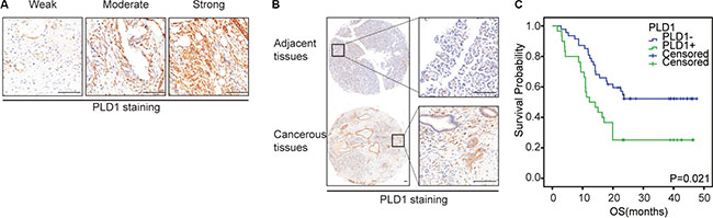 Representative immunohistochemical staining of Sp1 (A-C) and PLD1 (D-E) in PDAC.