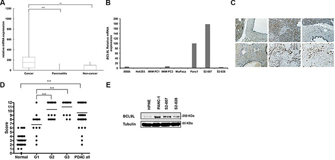 BCL9L expression in primary pancreatic tumor tissue and cell lines.