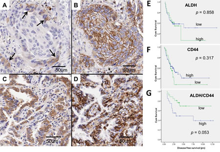 ALDH and CD44 expression in clinical lung cancers.