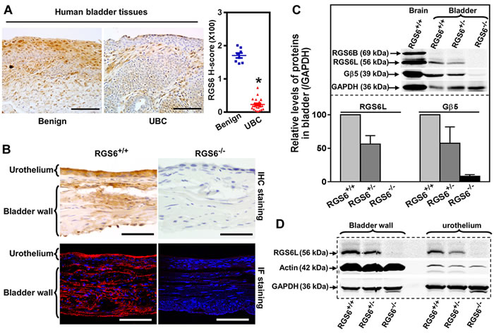 RGS6 is robustly expressed in human and mouse bladder and lost in human bladder tumors.
