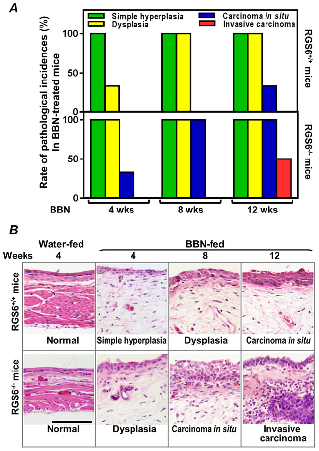 RGS6 inhibits BBN-induced bladder carcinogenesis.