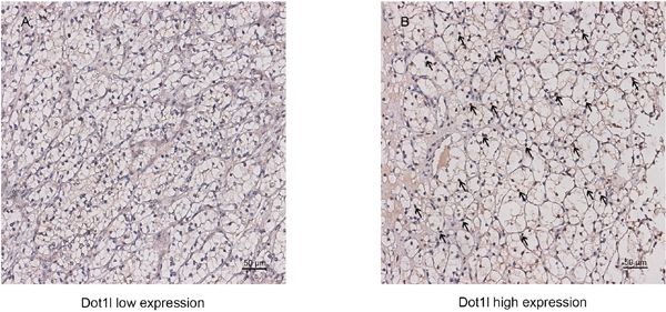 Dot1l expression in clear-cell renal cell carcinoma (ccRCC) tissues.