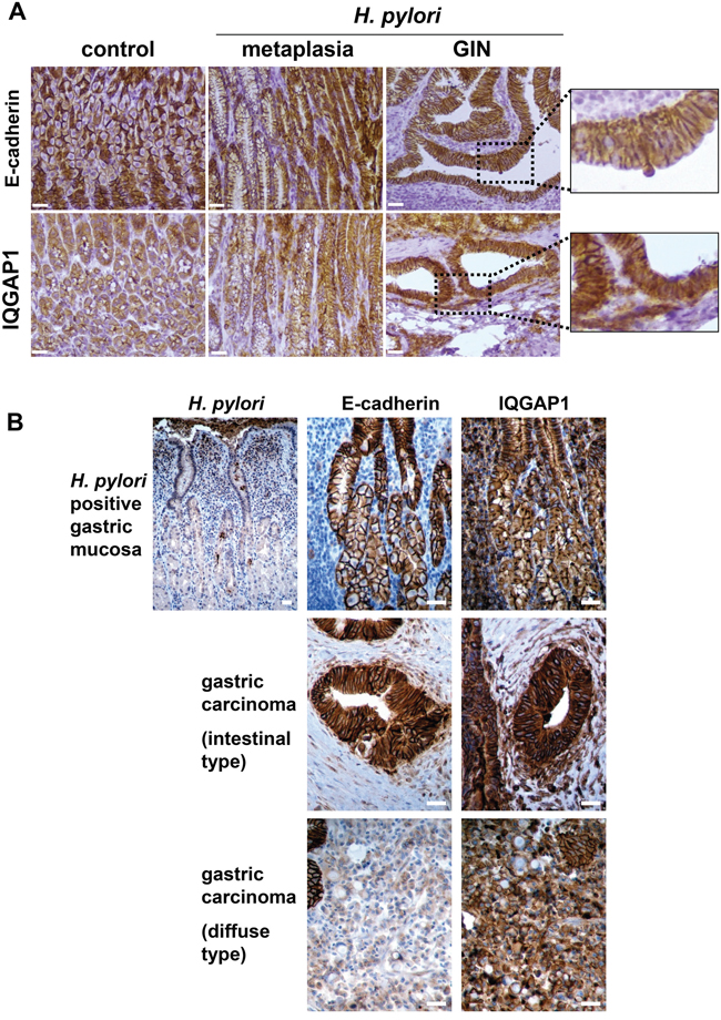 Expression of IQGAP1 and E-cadherin in gastric mucosa of mice and humans infected by Helicobacter pylori and in GIN and gastric carcinoma.