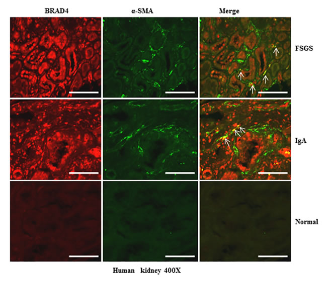 Brd4 is expressed in renal tubular cells and interstitial fibroblasts in human CKD.