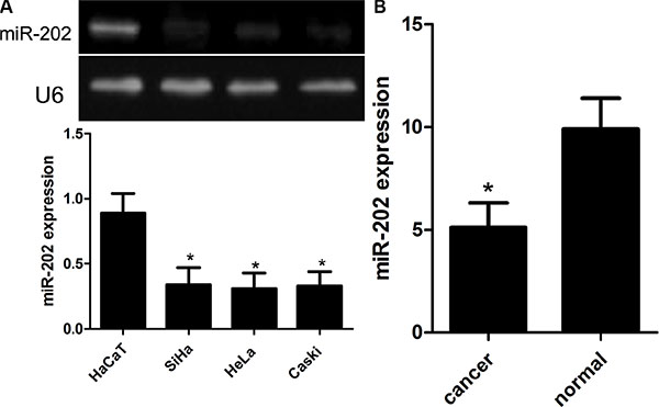 Reduced miR-202 expression in CC cell lines and tissues.