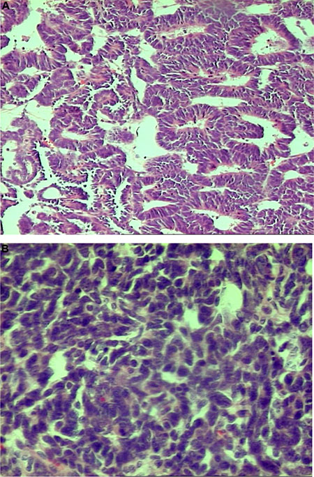 Photo 2: Nephroblastoma &#x2013; well-differentiated epithelial type, H&#x0026;E, oryg. magn. 100&#x00D7; (2A-top) presented higher values of &#x03B4;15N and &#x03B4;13C than the poorly-differentiated type, H&#x0026;E, oryg. magn. 200&#x00D7; (2B-bottom).