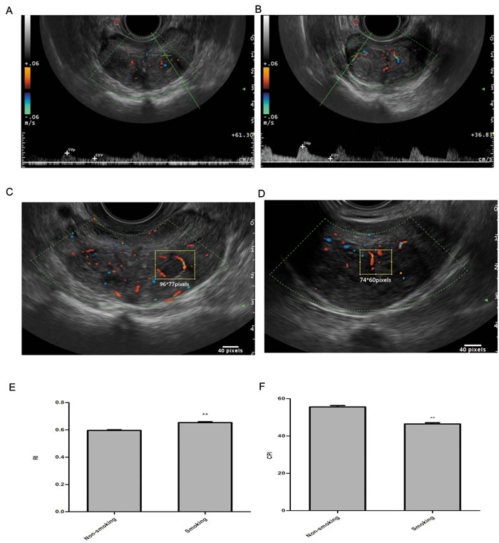 Representative images and analysis of RI and CPI in transrectal colour Doppler ultrasound on prostatic blood flow.