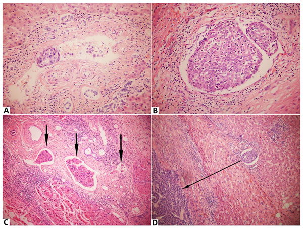 Stained with hematoxylin and eosin in hepatocellular carcinoma with microvascular invasion.