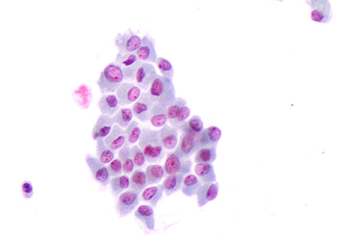 Details of the morphological features of plump cells and sickle shape nuclei in a cluster of &#x201c;positive for malignancy&#x201d; thyroid cells on liquid based cytology (LBC, 40X)