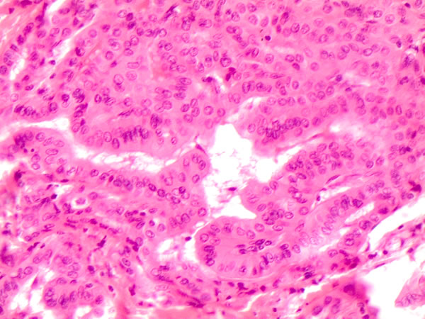 Specific histological details of polygonal cells with homogeneous eosinophilic cytoplasm (plump cells) in the bottom of the picture obtained from a Follicular variant of PTC (FVPC- H&amp;E 60X)