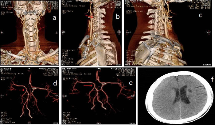 CT-angiography and brain magnetic resonance imaging (MRI).