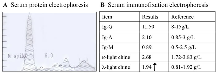 Serum protein and immunofixation electrophoresis revealed monoclonal protein (&#x3bb;-light chain in the &#x3b3; region)