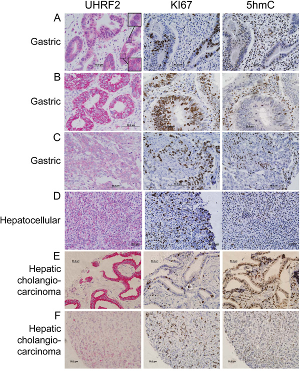 UHRF2 protein levels are mislocalized or reduced compared to normal tissue in gastric and hepatocellular human tumors.
