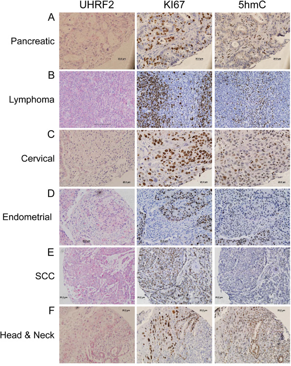 UHRF2 protein levels are reduced across numerous different human tumor types.