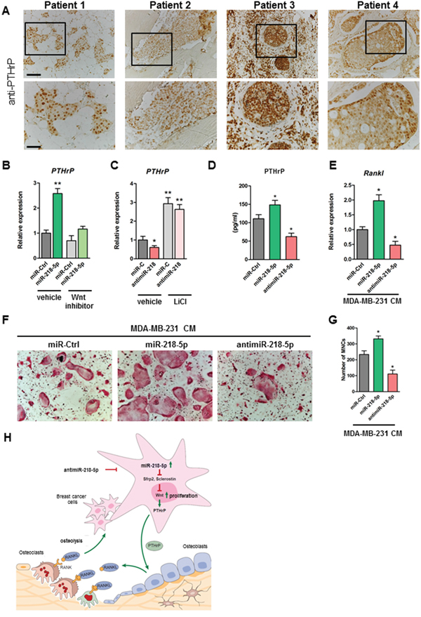 Inhibition of miR-218-5p in breast cancer cells decreases PTHrP expression, reduces Rankl in osteoblasts and impairs osteoclast differentiation.