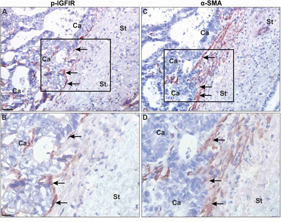 Myofibroblasts at the periphery of colorectal carcinoma liver metastases express activated IGF-IR.