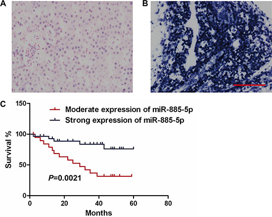 Low miR-885-5p expression correlates with poor survival of HCC patients.