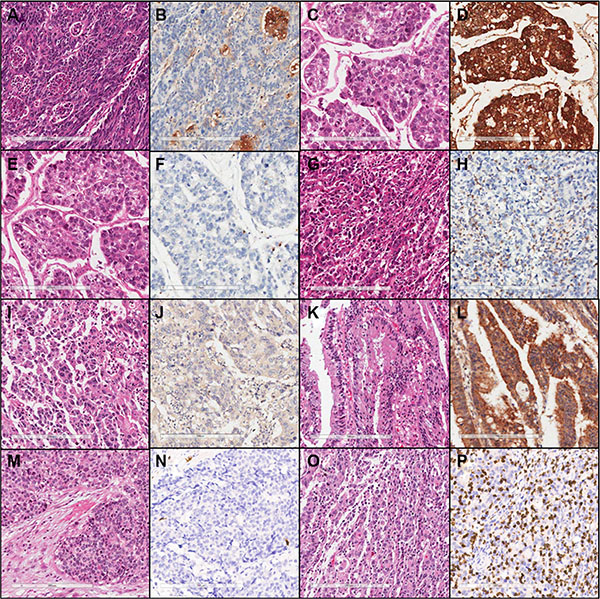 Representative microscopic images of hematoxylin &#x0026; eosin and immunohistochemical staining (&#x00D7;200) of low PD-L1 (A, B), high PD-L1 (C, D), low PD-1 (E, F), high PD-1 (G, H), low CTLA-4 (I, J), high CTLA-4 (K, L), low CD8 (M, N), and high CD8 expression (O, P).