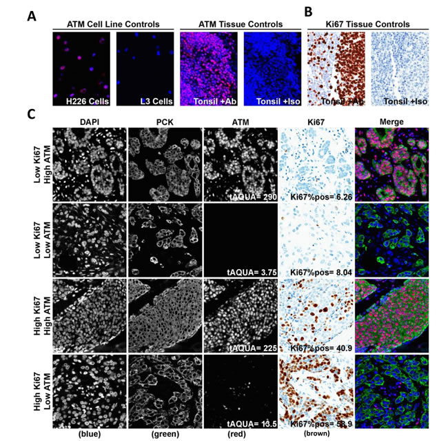 Semi-quantitative fluorescence immunohistochemistry and digital image analysis for ATM and Ki67 in ES-HPBC.