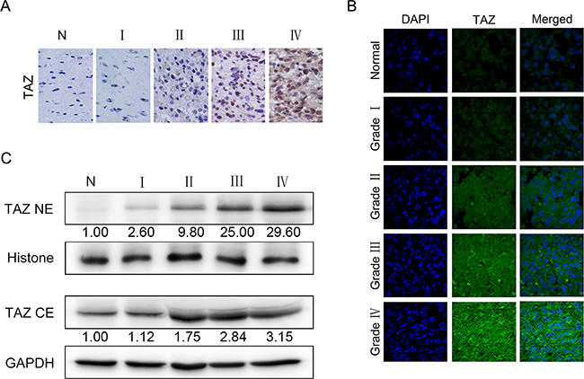 Localization and expression of TAZ in glioma specimens.