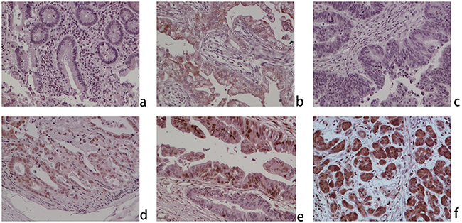 ZNF703 is overexpressed in human cholangiocarcinoma through immunohistochemical analysis (original magnification, x100).