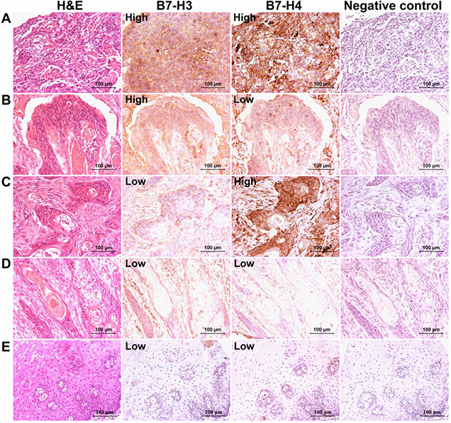 B7-H3 and B7-H4 immunostaining in human esophageal cancer tissues.