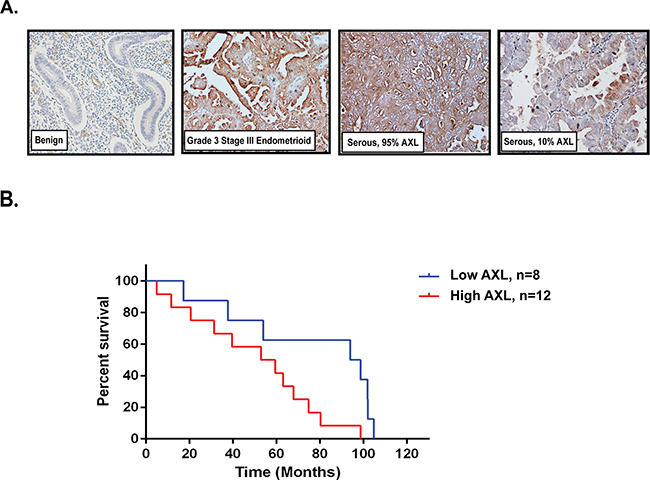 High AXL expression in endometrial tumors correlates with lower survival.