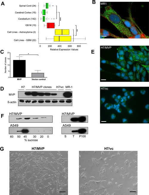 MVP expression in GBM and establishment of stable MVP-overexpressing H7 sublines.