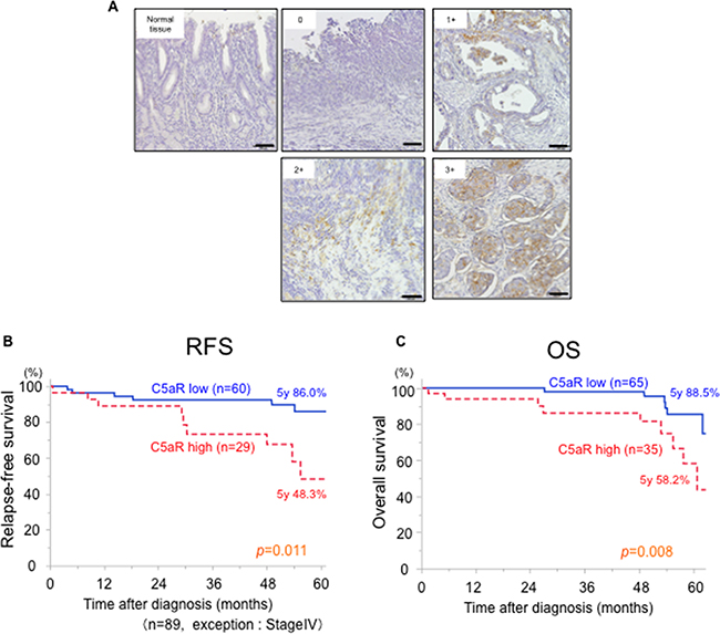 Relationship between C5aR expression and the prognosis of patients with gastric cancer.
