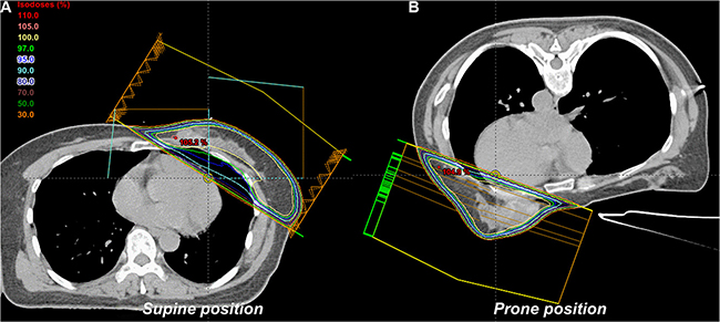 Radiotherapy plan in the (A) supine and (B) prone position.