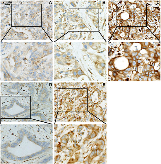 B7-H4 expression in liver metastases from pancreatic cancer.