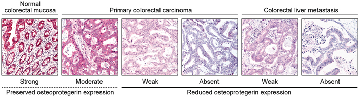 Osteoprotegerin immunoreactivity in normal colorectal mucosa, primary colorectal carcinoma, and colorectal liver metastasis.