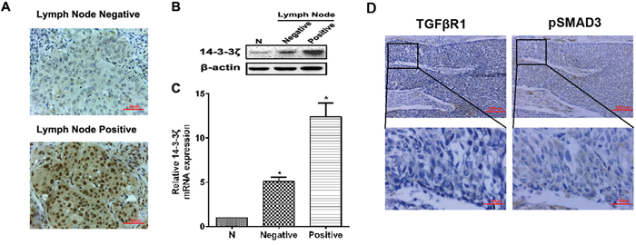The expression of 14-3-3&#x03B6;, TGF&#x03B2;R1 and pSMAD3 proteins in lung SCC tissues and the relationship with clinicopathological characteristics.