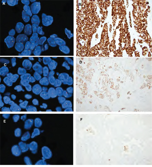 Examples of ALK FISH patterns and ALK IHC.