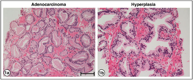 H&#x0026;E staining of PrCa and BPH.