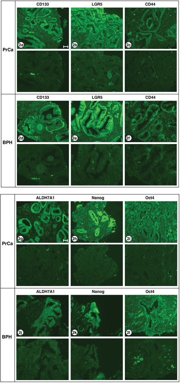 Stem cell markers expressed in PrCa and BPH.