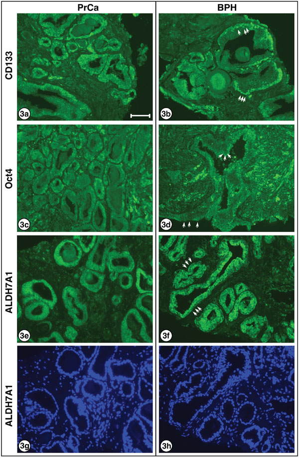 Higher resolution for CD133, Oct4 and and ALDH7A1 in PrCa and BPH.