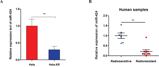 miR-424 expression was decreased in radioresistant Hela cells (Hela-XR) and specimens from cervical cancer patients with radioresistance.